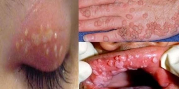 HPV Enfeksiyonu ile İlgili Önleyici Tedbirler Neler