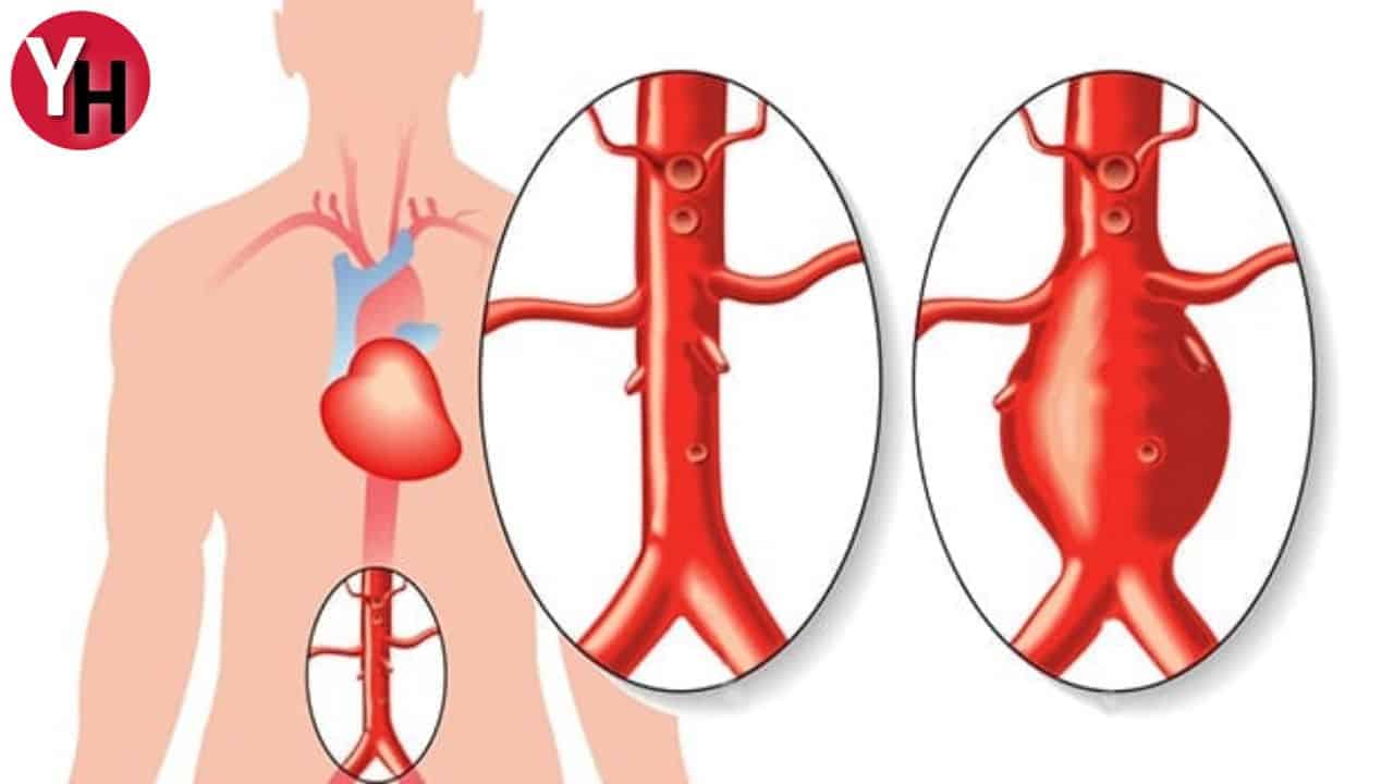 anevrizma-ve-ilaclar.jpg