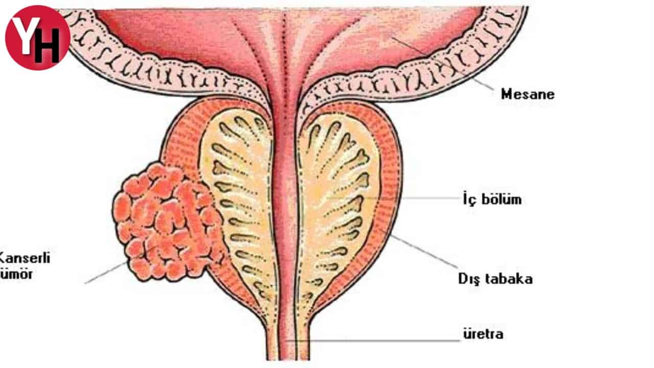 prostat-kanseri-4.jpg