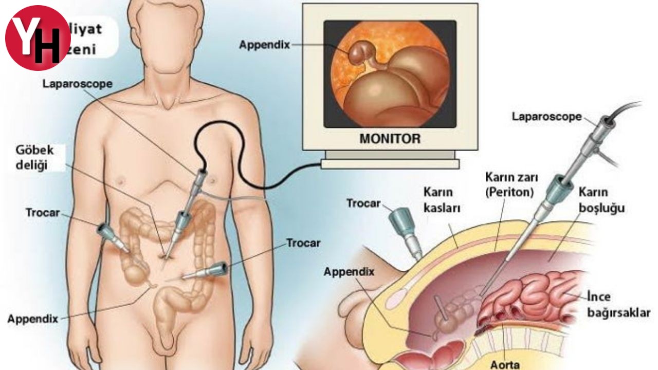 Kapalı Ve Açık Apendektomi (1)